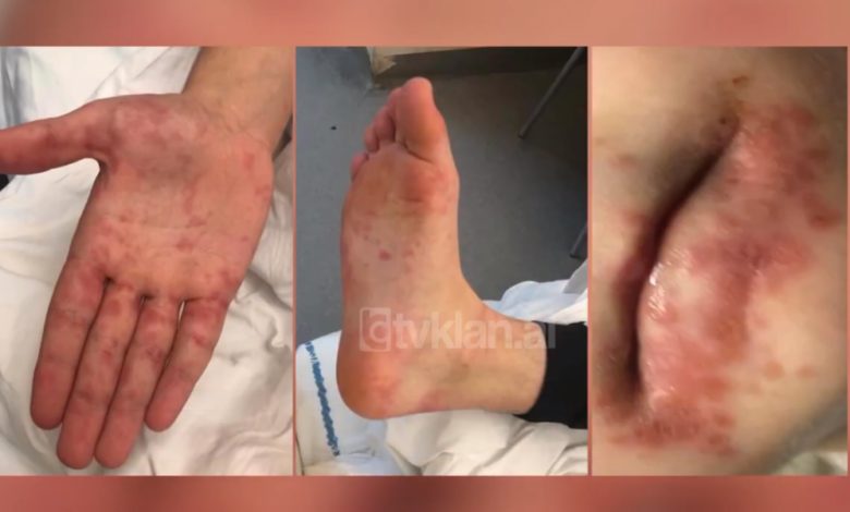 ALARMANTE: Një tjetër virus shfaqet në Shqipëri, po prek fëmijët e vegjël 1